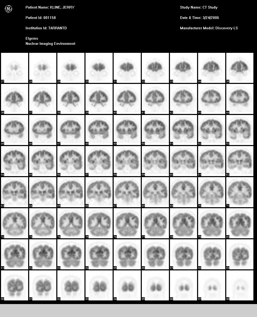 Coronal PET Images